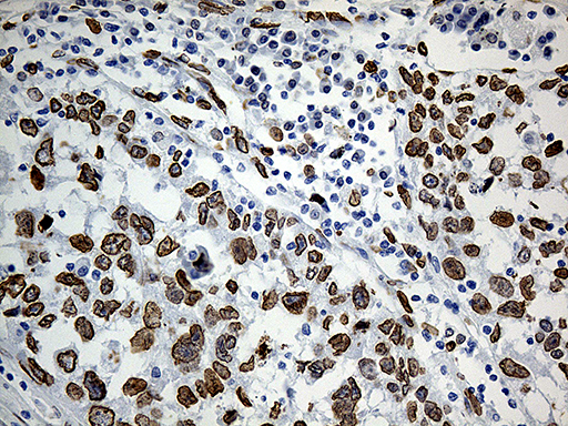 Immunohistochemical staining of paraffin-embedded Carcinoma of Human lung tissue using anti-SLU7 mouse monoclonal antibody
