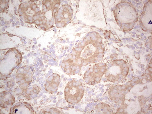 Immunohistochemical staining of paraffin-embedded Adenocarcinoma of Human breast tissue using anti-EFNA3 mouse monoclonal antibody