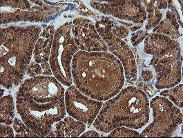 Immunohistochemical staining of paraffin-embedded Carcinoma of Human thyroid tissue using anti-RTKN mouse monoclonal antibody