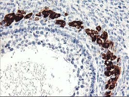 Immunohistochemical staining of paraffin-embedded Adenocarcinoma of Human ovary tissue using anti-PTPN7 mouse monoclonal antibody