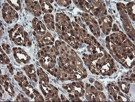Immunohistochemical staining of paraffin-embedded Carcinoma of Human thyroid tissue using anti-SDSL mouse monoclonal antibody