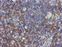 Immunohistochemical staining of paraffin-embedded Human lymphoma tissue using anti-NMT2 mouse monoclonal antibody