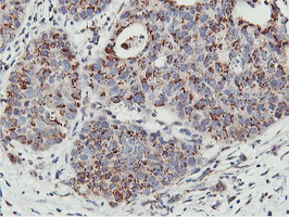 Immunohistochemical staining of paraffin-embedded Carcinoma of Human lung tissue using anti-NMT2 mouse monoclonal antibody