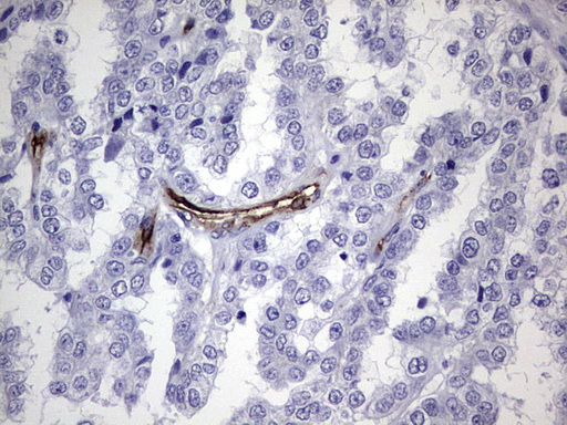 Immunohistochemical staining of paraffin-embedded Adenocarcinoma of Human ovary tissue using anti-CDH4 mouse monoclonal antibody
