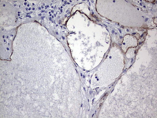 Immunohistochemical staining of paraffin-embedded Human thyroid tissue within the normal limits using anti-CDH4 mouse monoclonal antibody