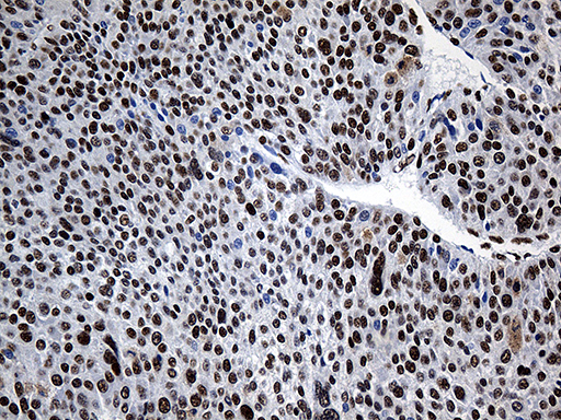 Immunohistochemical staining of paraffin-embedded Carcinoma of Human lung tissue using anti-HNRNPH1 mouse monoclonal antibody