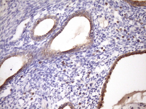Immunohistochemical staining of paraffin-embedded Carcinoma of Human pancreas tissue using anti-MCEE mouse monoclonal antibody