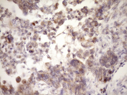 Immunohistochemical staining of paraffin-embedded Adenocarcinoma of Human endometrium tissue using anti-MCEE mouse monoclonal antibody