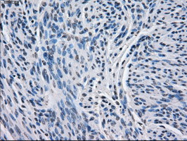 Immunohistochemical staining of paraffin-embedded Human endometrium tissue within the normal limits using anti-BCKDK mouse monoclonal antibody