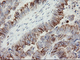 Immunohistochemical staining of paraffin-embedded Adenocarcinoma of Human ovary tissue using anti-PHKG2 mouse monoclonal antibody
