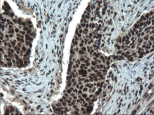 Immunohistochemical staining of paraffin-embedded Carcinoma of Human lung tissue using anti-RPRD1B mouse monoclonal antibody