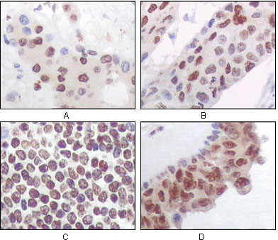 Immunohistochemistry analysis of paraffin-embedded human liver carcinoma (A), esophagus carcinoma (B), normal spleen tissue (C), breast carcinoma (D), showing nuclear and cytoplasmic localization with DAB staining using PRAK Monoclonal Antibody