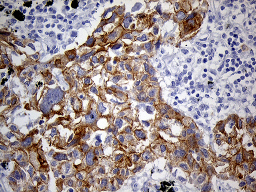 Immunohistochemical staining of paraffin-embedded Carcinoma of Human lung tissue using anti-LAD1 mouse monoclonal antibody