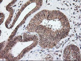 Immunohistochemical staining of paraffin-embedded Adenocarcinoma of Human endometrium tissue using anti-NUDT9 mouse monoclonal antibody