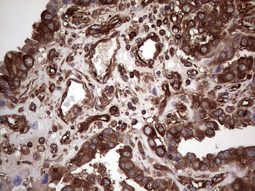 Immunohistochemical staining of paraffin-embedded Adenocarcinoma of Human ovary tissue using anti-LRRTM1 mouse monoclonal antibody