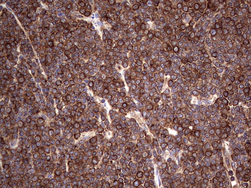 Immunohistochemical staining of paraffin-embedded Human lymphoma tissue using anti-LRRTM1 mouse monoclonal antibody