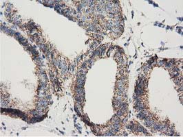 Immunohistochemical staining of paraffin-embedded Adenocarcinoma of Human endometrium tissue using anti-AK3 mouse monoclonal antibody