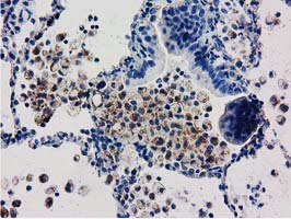 Immunohistochemical staining of paraffin-embedded Carcinoma of Human lung tissue using anti-AK3 mouse monoclonal antibody