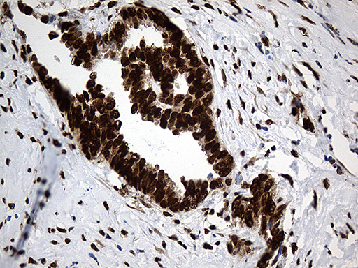 Immunohistochemical staining of paraffin-embedded Adenocarcinoma of Human ovary tissue using anti-PTBP3 mouse monoclonal antibody