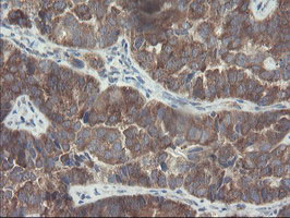 Immunohistochemical staining of paraffin-embedded Adenocarcinoma of Human ovary tissue using anti-VBP1 mouse monoclonal antibody