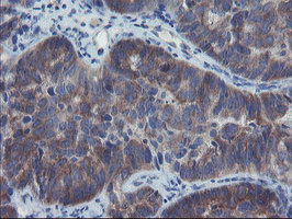 Immunohistochemical staining of paraffin-embedded Adenocarcinoma of Human ovary tissue using anti-VBP1 mouse monoclonal antibody