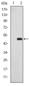Immunohistochemistry analysis of paraffin-embedded human liver cancer tissues with DAB staining using SAPAP1 Monoclonal Antibody