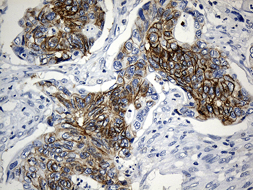 Immunohistochemical staining of paraffin-embedded Adenocarcinoma of Human colon tissue using anti-CEP72 mouse monoclonal antibody