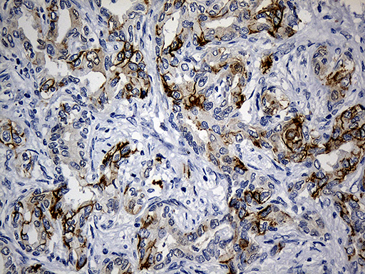 Immunohistochemical staining of paraffin-embedded Carcinoma of Human liver tissue using anti-CEP72 mouse monoclonal antibody