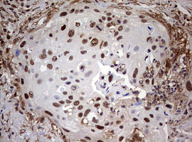 Immunohistochemical staining of paraffin-embedded Carcinoma of Human lung tissue using anti-USP44 mouse monoclonal antibody