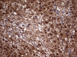 Immunohistochemical staining of paraffin-embedded Adenocarcinoma of Human ovary tissue using anti-USP44 mouse monoclonal antibody