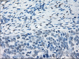 Immunohistochemical staining of paraffin-embedded Adenocarcinoma of ovary tissue using anti-NAT8mouse monoclonal antibody