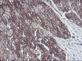 Immunohistochemical staining of paraffin-embedded Adenocarcinoma of Human ovary tissue using anti-NPTN mouse monoclonal antibody