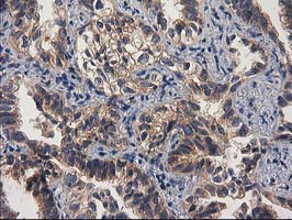 Immunohistochemical staining of paraffin-embedded Carcinoma of Human lung tissue using anti-GBA3 mouse monoclonal antibody