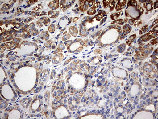 Immunohistochemical staining of paraffin-embedded Carcinoma of Human thyroid tissue using anti-KLHL12 mouse monoclonal antibody
