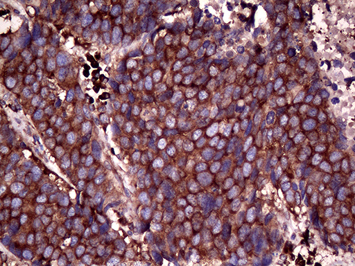 Immunohistochemical staining of paraffin-embedded Carcinoma of Human lung tissue using anti-RPL10A mouse monoclonal antibody