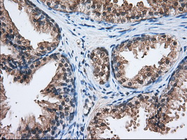 Immunohistochemical staining of paraffin-embedded Human prostate tissue within the normal limits using anti-C17orf28 mouse monoclonal antibody. (Heat-induced epitope retrieval by 10mM citric buffer Immunohistochemical staining of paraffin-embedded Human prostate tissue within the normal limits using anti-C17orf28 mouse monoclonal antibody. (Heat-induced epitope retrieval by 10mM citric buffer