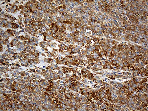 Immunohistochemical staining of paraffin-embedded Adenocarcinoma of Human breast tissue tissue using anti-UBA7 mouse monoclonal antibody