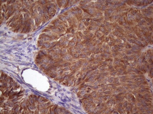 Immunohistochemical staining of paraffin-embedded Adenocarcinoma of Human ovary tissue using anti-NDUFB11 mouse monoclonal antibody