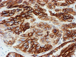 Immunohistochemical staining of paraffin-embedded Adenocarcinoma of Human ovary tissue using anti-FXYD3 mouse monoclonal antibody