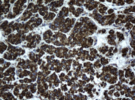 Immunohistochemical staining of paraffin-embedded Carcinoma of Human liver tissue using anti-HSD17B8 mouse monoclonal antibody