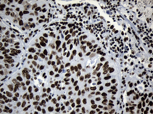 Immunohistochemical staining of paraffin-embedded Carcinoma of Human lung tissue using anti-MED19 mouse monoclonal antibody