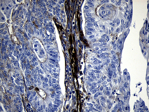 Immunohistochemical staining of paraffin-embedded Adenocarcinoma of Human endometrium tissue using anti-MYL1 mouse monoclonal antibody