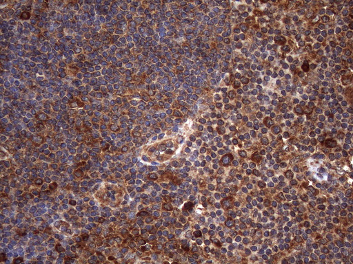 Immunohistochemical staining of paraffin-embedded Carcinoma of Human lung tissue using anti-NARS2 mouse monoclonal antibody. (Heat-induced epitope retrieval by 1mM EDTA in 10mM Tris buffer (pH8.5) at 120°C for 3min