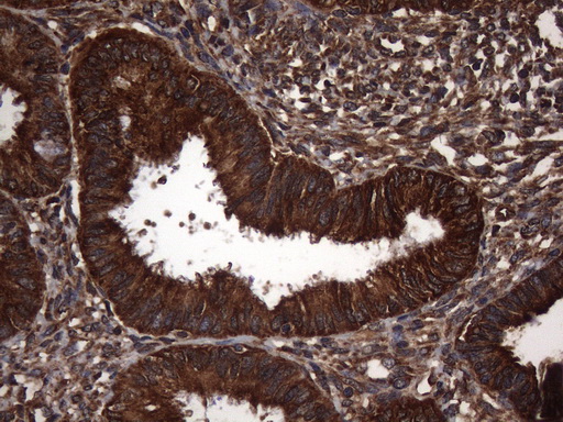 Immunohistochemical staining of paraffin-embedded Adenocarcinoma of Human endometrium tissue using anti-NARS2 mouse monoclonal antibody. (Heat-induced epitope retrieval by 1mM EDTA in 10mM Tris buffer (pH8.5) at 120°C for 3min