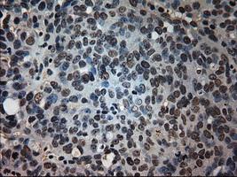 Immunohistochemical staining of paraffin-embedded Adenocarcinoma of ovary tissue using anti-PROM2mouse monoclonal antibody