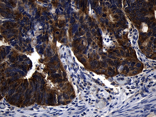 Immunohistochemical staining of paraffin-embedded Adenocarcinoma of Human colon tissue using anti-RNF14 mouse monoclonal antibody