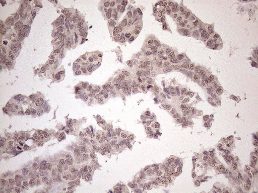 Immunohistochemical staining of paraffin-embedded Adenocarcinoma of Human ovary tissue using anti-SCML2 mouse monoclonal antibody