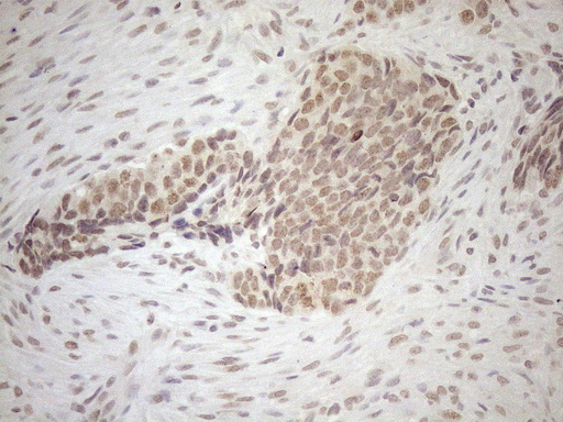 Immunohistochemical staining of paraffin-embedded Adenocarcinoma of Human endometrium tissue using anti-SCML2 mouse monoclonal antibody