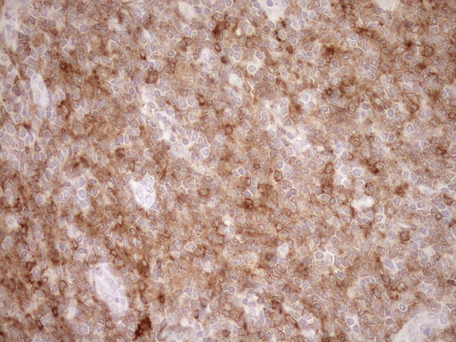 Immunohistochemical staining of paraffin-embedded Human lymphoma tissue using anti-SAMSN1 mouse monoclonal antibody