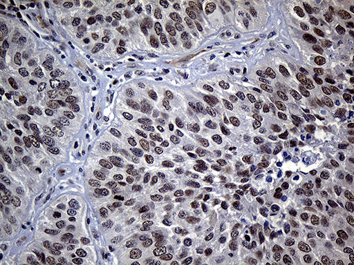Immunohistochemical staining of paraffin-embedded Carcinoma of Human lung tissue using anti-NEMF mouse monoclonal antibody